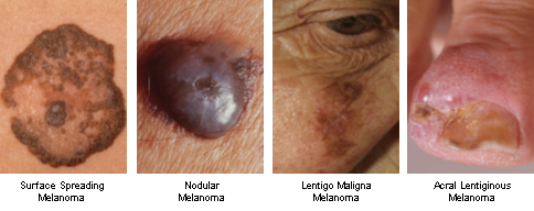 superficial spreading malignant melanoma